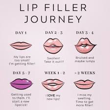 To###edddddd , · photos from lips of london . Aesthetics By Jeni On Twitter This Is So True Lip Lipfiller Lips Fillers Fillersinjection Fillerlips Dermalfiller Kent Eastsussex Surrey Medway Tonbridge Uk London Lipfillerlondon Cosmeticinjectibles Instalips Plump Nearme
