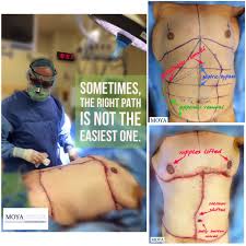 10 Hours In The Or Helped Give This 33 Y O Man The Body Shape He Had Worked So Hard To Achieve At 6 3 He Had Once Weighed 500 Pounds But Now Had Only