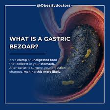 Image result for Bezoar