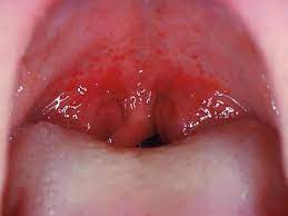 In others, it can indicate an infection or condition that needs to be treated medically. Red Spots On Roof Of Mouth Causes And Other Symptoms