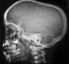 Silver beaten skull also refers to the same condition. Copper Beaten Skull In X Linked Hypophosphataemic Rickets Springerlink