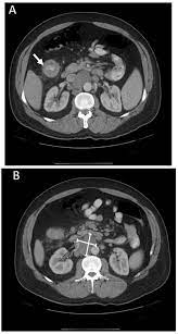 Positron emission tomography (pet) scan for a pet scan, a slightly radioactive form of sugar (known as fdg) is injected into the blood and collects mainly in cancer cells. Colon Cancer Metastasis To Mediastinal Lymph Nodes Without Liver Or Lung Involvement A Case Report