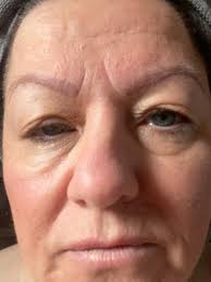 I had the surgery and never looked back. So happy. Would do it again in a  heart beat. Looks awful after surgery but not much pain.