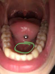 I Recently Got My Tongue Pierced And It S Doing Okay The Worst Issue Im Having Is That The Bottom Ball Is Constantly Rubbing On My Bottom Jaw Gum Area It S So Swollen