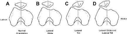 Image result for Patella Mobility Test