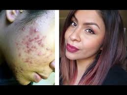 How I Used Apple Cider Vinegar To Clear My Skin Get Rid Of Acne Youtube