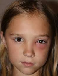 Pin Auf Pediatric Ophthalmology