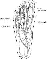 mortons neuroma intermetatarsal neuroma foot health facts