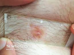 Image result for Diascopy