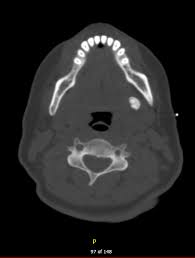 Image result for Sialolithiasis