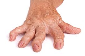Rheumatoid Arthritis Pictures Symptoms In The Joints