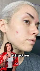 Baddies have ACNE, too 👸🏼😍 She used TheAcneMethod.com to heal her acne  though! 👏🏼 @sammy_grimm #acne #skincare #acnetreatment #pimples  #skinpositivity #acnepositivity #skincareaddict #teamacne