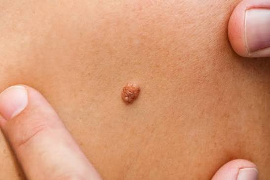 Moles and Skin Growths - Cornerstone Dermatology & Surgery Group