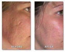Scar Removal Rodan Fields Skin Care Skin Care Acne Acne Scar Removal