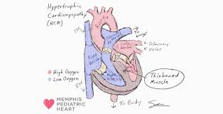 Image result for Cardiomyopathy