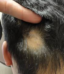 In women, rogaine is applied topically to the scalp in the area of hair loss, either as a 2 percent solution or a 5 percent foam. Minoxidil Use In Alopecia Areata Useful Or Not Donovan Hair Clinic