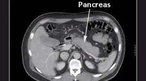 Order an imaging study, like a computed tomography (ct) scan or magnetic resonance imaging (mri) get a tissue sample, called a biopsy; Video Advances In Pancreatic Ct And Mr Imaging Imaging Technology News