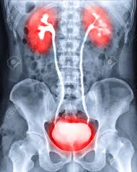 Image result for Intravenous Pyelogram