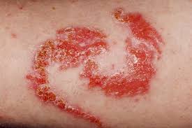Image result for contact dermatitis