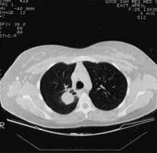Maybe you would like to learn more about one of these? Intrapulmonary Benign Fibrous Tumor Of The Pleura The Journal Of Thoracic And Cardiovascular Surgery