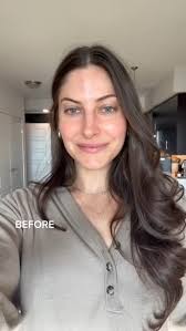 This beautiful patient came to us seeking subtle, natural changes—and the  result is a more balanced and harmonious profile 💫 We’re so honored to  work with such a gorgeous face, and we hope this ...