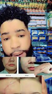 Dhaawac wajiga haduu kaga yalo ama la dhiban tahay firito ama gubasho ...