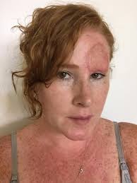 Woman's incredible skin cancer photo diary shows the reality of melanoma.