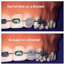 As a result, you must thoroughly wash your hands before touching the wax. 9 Best What To Use Instead Of Dental Wax On Your Braces Ideas Braces Dental Dental Braces