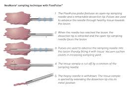 There are various types of biopsy that can be used to help identify a wide range of health conditions. Needles For All Types Of Ultrasound Guided Biopsies Neodynamics