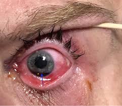 Image result for Hyphema