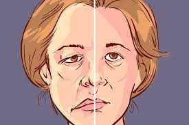 As noted previously, bell's palsy occurs as a manifestation of the body's reaction to microbial infection of the structures surrounding the seventh cranial nerve. Bell S Palsy What Is It Symptoms Causes And Treatment Tua Saude