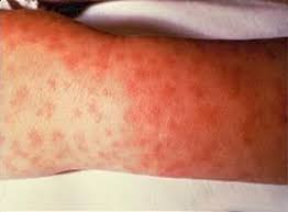 Ticks And Diseases
