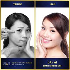 Hút Mỡ Face Beauty