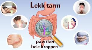 I disse lommene kan det samle seg avføring og bakterier, som igjen kan føre til en betennelse. Lekk Tarm Og Eller Matintoleranser Er En Av Hovedarsakene Til Overvekt Margrethe Skar Helseveileder