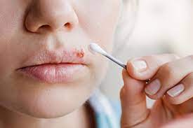 Dabei ist der herpes genitalis wesentlich gefährlicher, als man nach landläufiger meinung annimmt: Herpesblaschen Das Sollten Sie Wissen Und Jetzt Tun Gala De