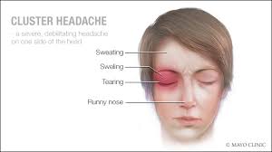 Image result for Cluster Headache