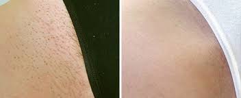 Tired of waxing, shaving and ingrown hairs? Laser Hair Removal Perth Azure Medical Cottesloe