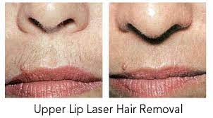 It also depends on how dense the hair is and how your hair responds to the treatments, some may get complete removal in just a few treatments while others may need more. Laser Hair Removal Treatment For Upper Lip Area In Porur Chennai Elegance Perfect Beauty Company Id 20392281330