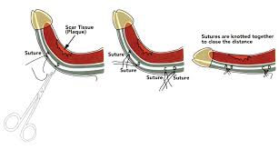 Peyronie's disease is a nonspecific term that describes penile curvature. Racgp Peyronie S Disease Watch Out For The Bend