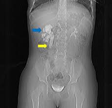 Image result for Intravenous Pyelogram