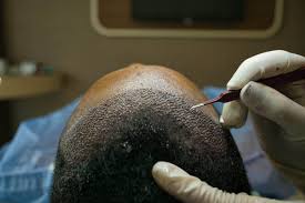 Hair Transplant