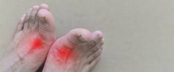 النقرس والصيام معلومات تهمك ويب طب