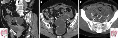 Whether larger colonic resections can undergo anastomosis, although the physiology would be expected to be the. Imaging The Operated Colon Using Water Enema Multidetector Ct With Emphasis On Surgical Anastomoses Insights Into Imaging Full Text