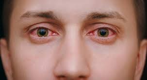 Image result for Viral Conjunctivitis