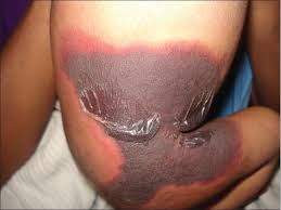 This produces a characteristic pattern of confluent purpura which progresses to gangrene, typically involving the extremities. Indian Journal Of Dermatology Venereology And Leprology Spectrum Of Purpura Fulminans Report Of Three Classical Prototypes And Review Of Management Strategies