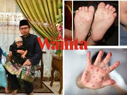 Ia biasanya bermula dengan demam dan rasa tidak sihat. Hfmd Dah Mula Menyerang Tolonglah Perhatikan Anak Anak Kalau Risau Terkena Penyakit Tangan Kaki Dan Mulut Mingguan Wanita