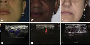 Diagnostic approach to intramasseteric nodules