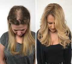 Hair fall treatment services from india. Hair Loss The Ultimate Answer Hairdreamsplus Salon