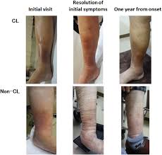 Image result for Lipodermatosclerosis