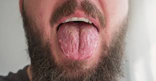 Image result for Fissured tongue